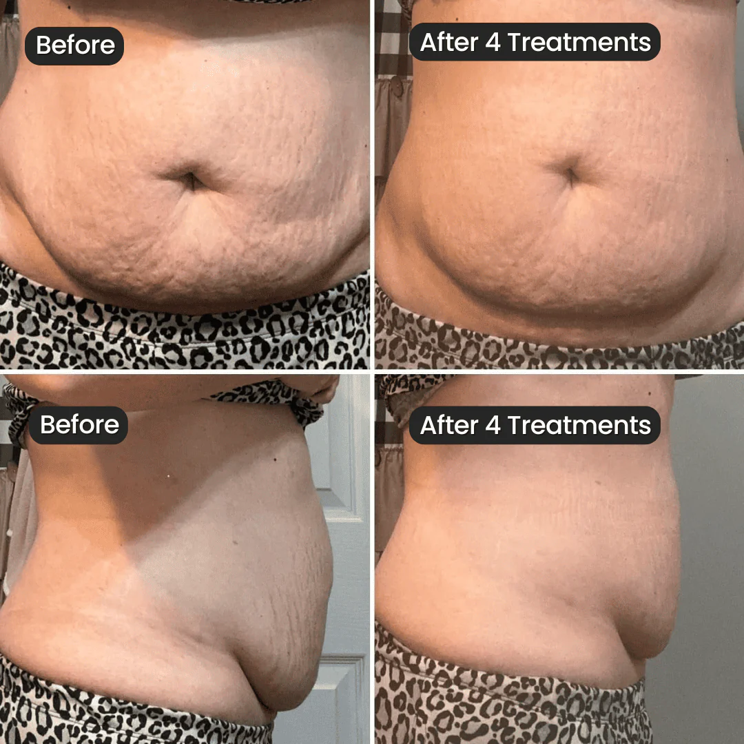 Eelhoe Stretch Mark Cream