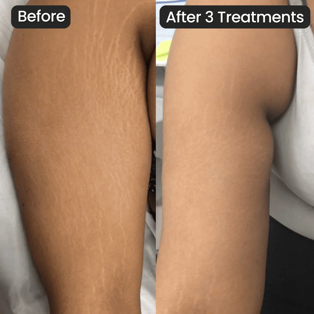 Eelhoe Stretch Mark Cream