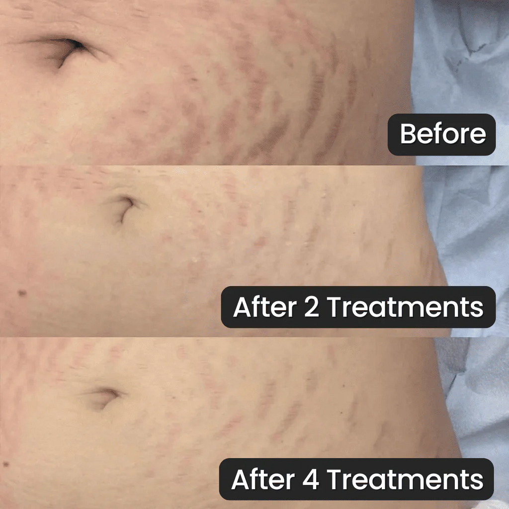 Eelhoe Stretch Mark Cream
