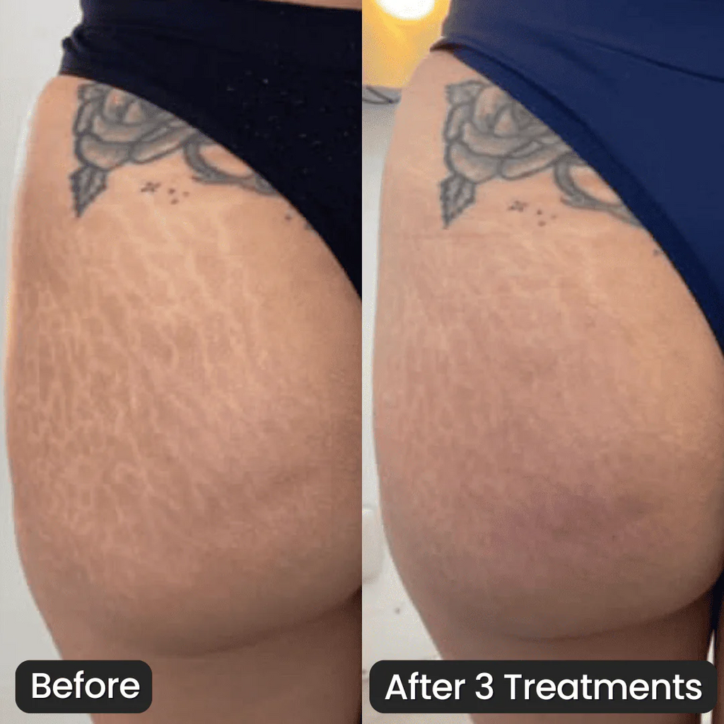 Eelhoe Stretch Mark Cream